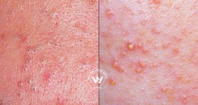 Difference between blackheads and whiteheads
