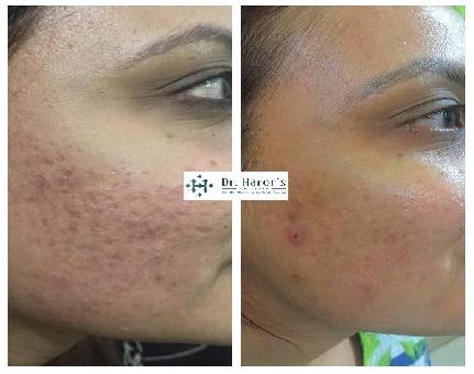 Skin Treatment in Rajouri Garden affordable Prices