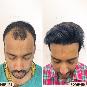 Best Leading Hair Transplant Surgeon in Gurugram 