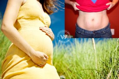 Post Pregnancy Stretch Marks - a worrisome issue for expecting mothers!