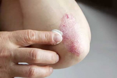 Five Common Skin Disorders and Their Symptoms