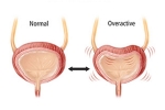 Overactive Bladder disadvantages, Overactive Bladder signs, here are some warning signs of an overactive bladder, Urinating