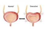 Overactive Bladder signs, Overactive Bladder updates, here are some warning signs of an overactive bladder, Caffeine