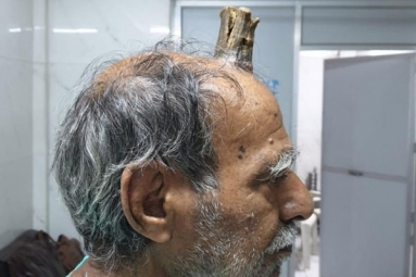 Indian Man Grows Devil’s Horn After Head Injury