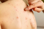 measles outbreak 2019, measles outbreak texas, measles outbreak in new york suburb unvaccinated children barred from public spaces, Jewish community