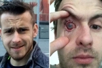contact lens wearers, lens in shower, contact lens wearers beware man goes blind after parasites eat man s eye as he wore lenses in shower, Cornea contact lens wearers, lens in shower, contact lens wearers beware man goes blind after parasites eat man s eye as he wore lenses in shower, Cornea