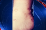 canceled, Foot ball game, phoenix union high school football game was canceled due to bacterial infection, Impetigo