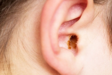 How to Remove Ear Wax? How to Remove Ear Wax?