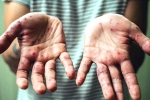 Tomato Flu breaking news, Tomato Flu in India, tomato flu scare in kerala and odisha, Blisters