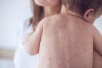 measles pictures, measles causes, measles back in the united states as children omit vaccination doses, Vaccination for children