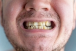 Nicotine stains good for health, Nicotine stains latest breaking, are nicotine stains on your teeth irreversible, Us recession