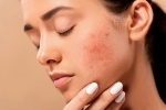 skin care, acne, 10 ways to get rid of pimples at home, Skin care products