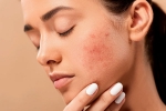 skin care products, pimples, 10 ways to get rid of pimples at home, Junk food