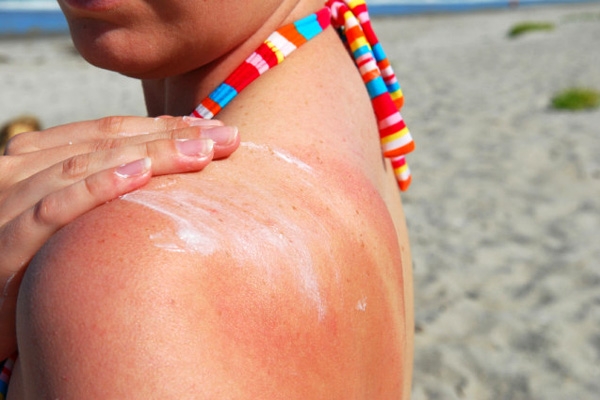 Sunburn Survival and Skin Nourishment tips },{Sunburn Survival and Skin Nourishment tips
