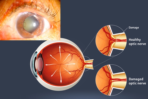 Hypertension causes Glaucoma},{Hypertension causes Glaucoma