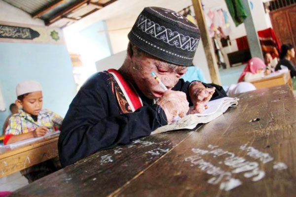 Meet 'Snake Boy' who sheds his skin after every two days},{Meet 'Snake Boy' who sheds his skin after every two days