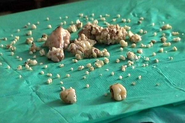 Dental surgeons extract 232 teeth from a teen's mouth},{Dental surgeons extract 232 teeth from a teen's mouth