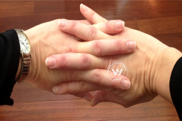 Can cracking knuckles cause osteoarthritis?},{Can cracking knuckles cause osteoarthritis?