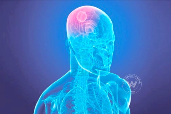 Scientists identify genes responsible for hard-to-treat brain tumors